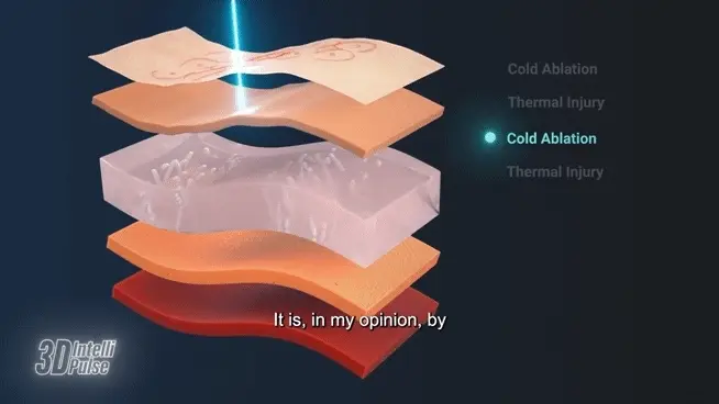 울트라클리어 3D IntelliPulse 원리 애니메이션 - 콜드 어블레이션(Cold Ablation)과 열 작용(Thermal injury)이 피부층에 전달되는 차이